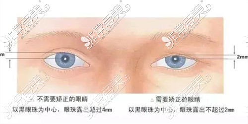 眼提肌改善检测