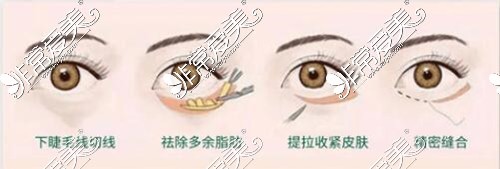 双眼皮手术操作失误会导致眼睛凹进去