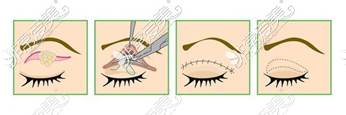 大小眼双眼皮手术示意图