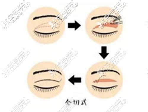 全切双眼皮手术