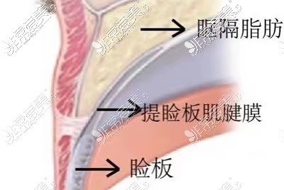 提睑板肌腱膜