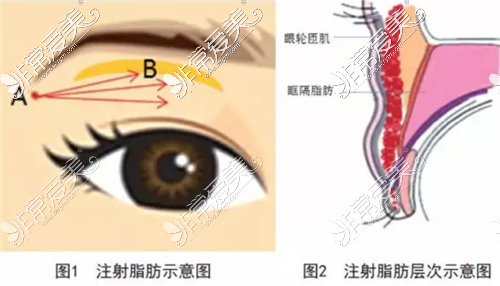 雙眼皮眼窩凹陷自體脂肪注射示意圖