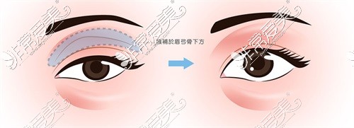 双眼皮眼窝凹陷填充位置示意图