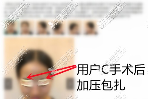 关于艺星美杜莎美眼用户C手术后进行加压包扎