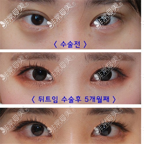 韩国双眼皮改单对比