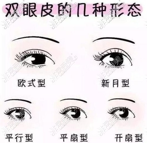双眼皮分为哪些类型