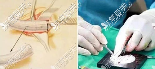 肋骨比雕刻过程 肋骨比雕刻过程