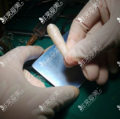 肋骨鼻假体照片 肋骨鼻假体照片