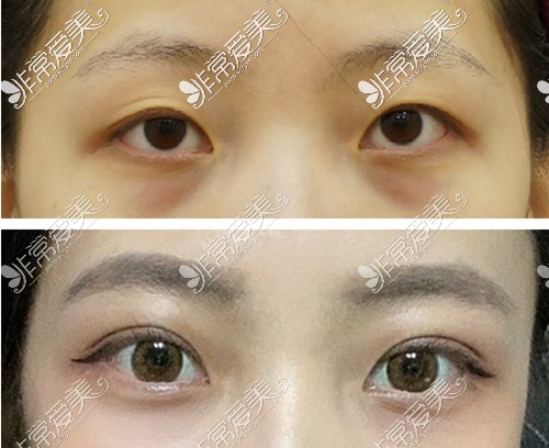 韩国美好MIHO整形眼部提肌疗效图示