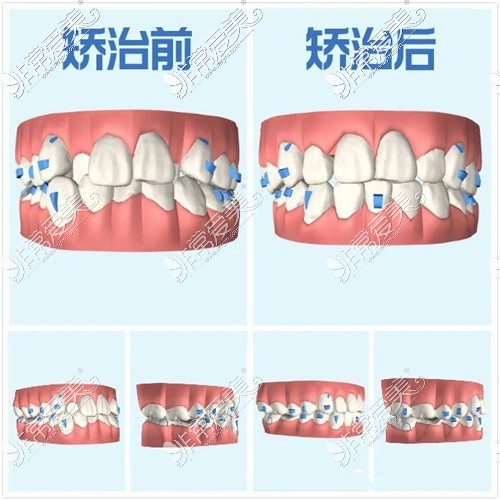 成都思迈口腔箍牙正畸前后对比