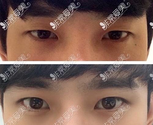 韩国美好MIHO整形男士眼部提肌前后对比图片