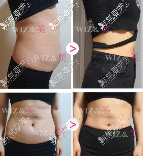 Wiz&美整形外科使用新技术APOLEX完成腰腹吸脂的例子