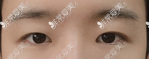 韩国美好MIHO整形自然风双眼皮术前图术后图