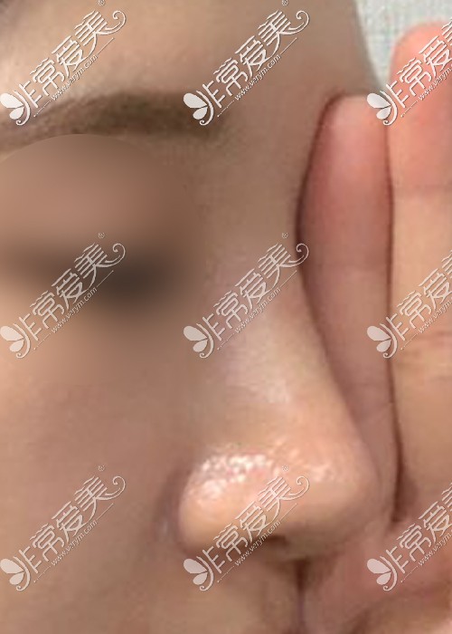 驼峰鼻矫正后照片