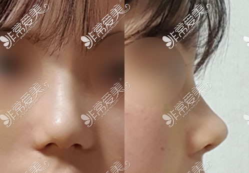 韩国美好整形外科鼻整形术后鼻形展示