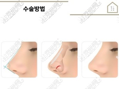 隆鼻术手术方法