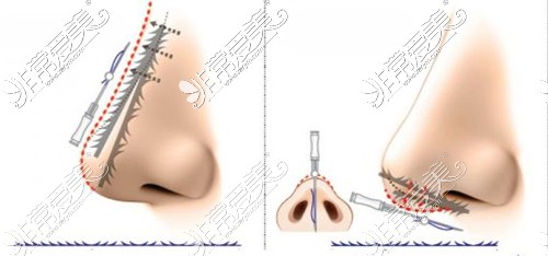 不同位置埋线隆鼻方式