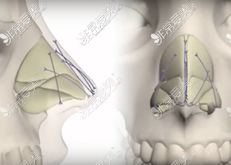 埋线隆鼻埋线隆鼻植入不同位置