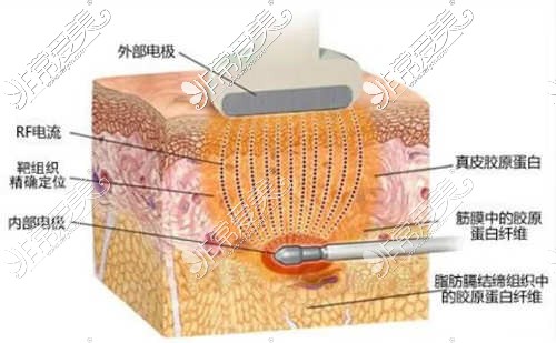 射频紧肤到达的皮肤层次