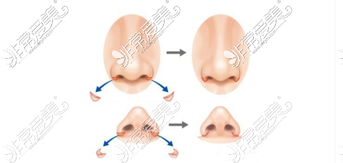 外切法缩小鼻翼