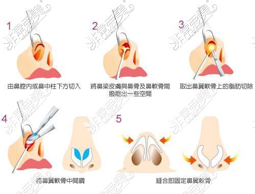 缩小鼻翼示意图