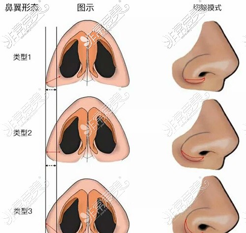 鼻翼缩小示意图