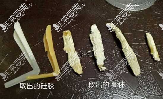 膨體隆鼻術(shù)后對比圖