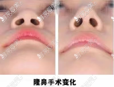隆鼻手术鼻头变化图