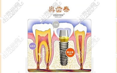 西安奥齿泰种植牙价钱多少贵不贵，中诺美奥都做得很不错