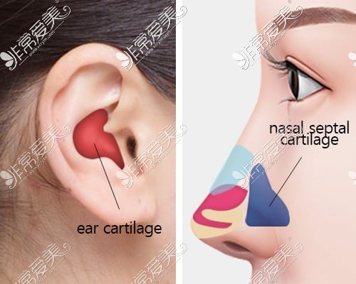 耳软骨隆鼻取出部位及植入部位