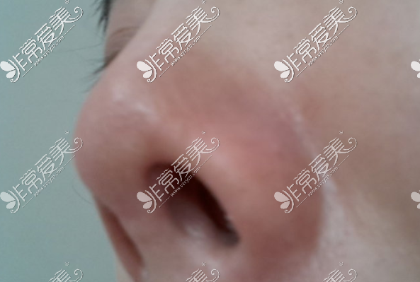 鼻子挛缩图片 前期图片
