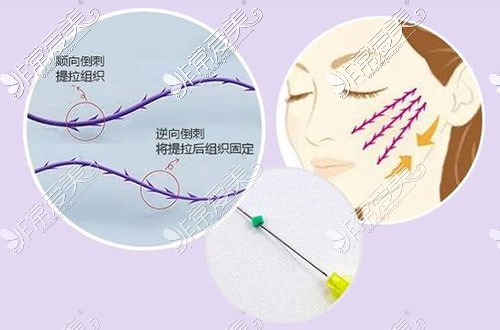 埋线提升线体提升角度示意图