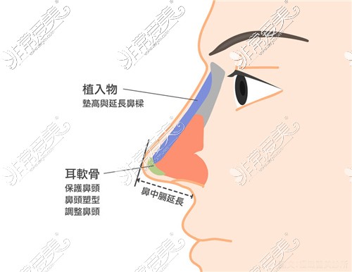 隆鼻示意图