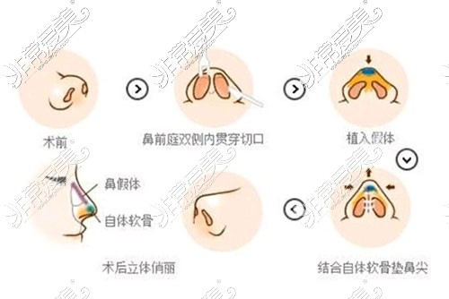 隆鼻手术示意图