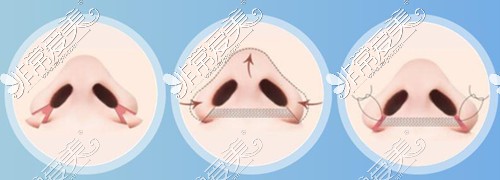 三种不同情况的瘦鼻翼方法