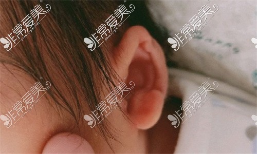 新生儿耳朵褶皱