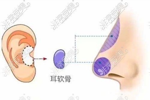 耳软骨隆鼻操作示意图