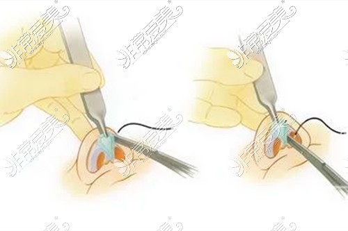 耳软骨隆鼻操作展示图