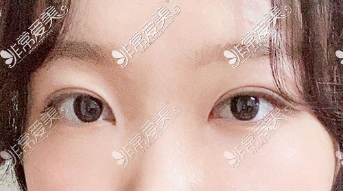 韩国yellow双眼皮术后一个月