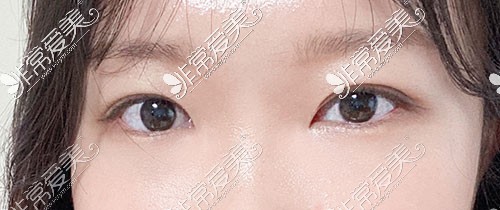 韩国yellow双眼皮手术图