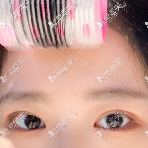 韩国yellow双眼皮整形照片