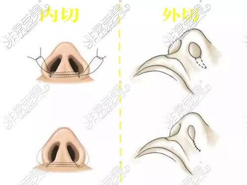 鼻翼缩小内切和外切术式