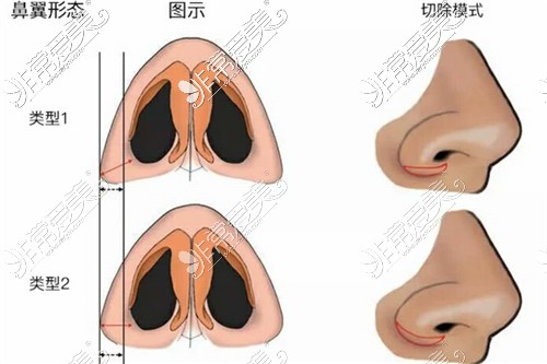 鼻翼形態(tài)不同手術方法