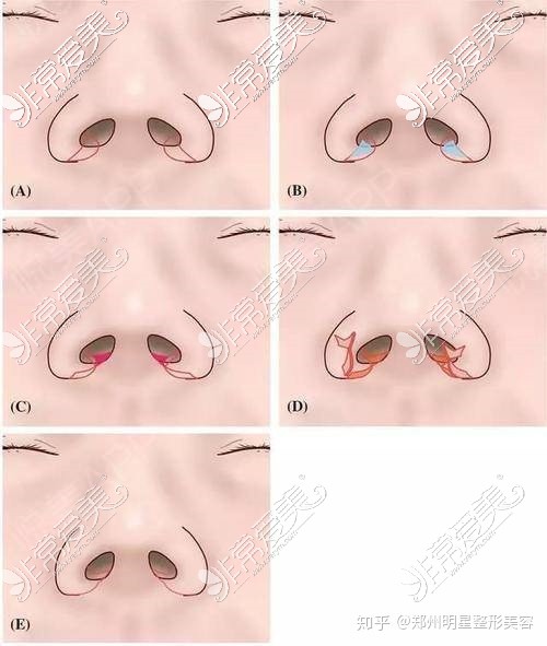缩鼻翼手术方式图