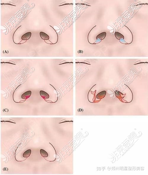 縮鼻翼手術(shù)方式圖