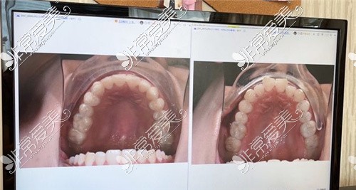 北京劲松口腔正畸对比照