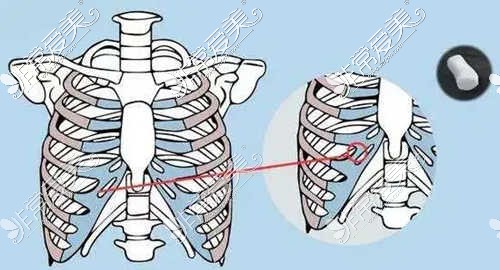 肋骨隆鼻取肋位置