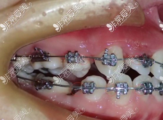 金属牙套矫正过程图片