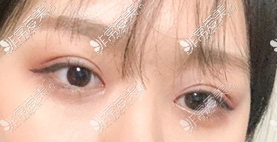 韩国yellow整形双眼皮照片