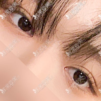 韩国yellow整形双眼皮图片